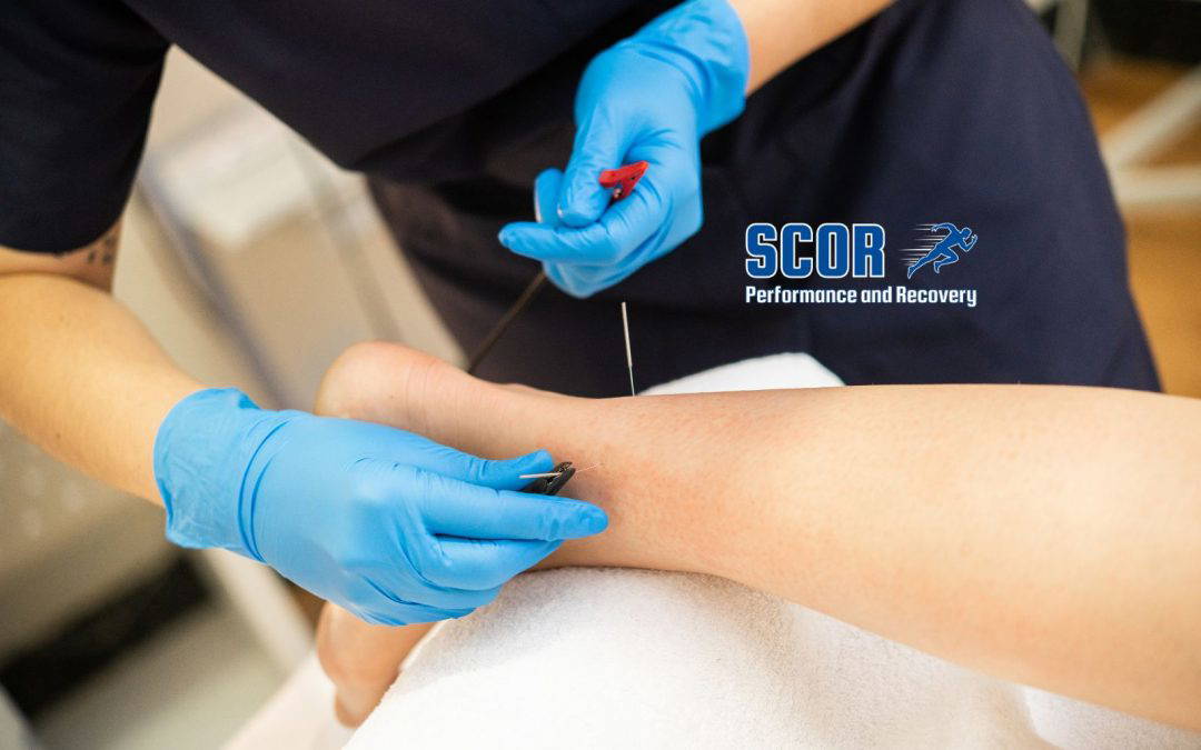 Does Dry Needling Hurt? What to Expect During and After Treatment