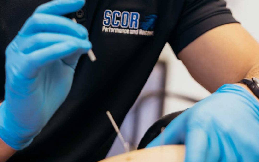 Dry Needling vs. Acupuncture: What’s Actually the Difference?